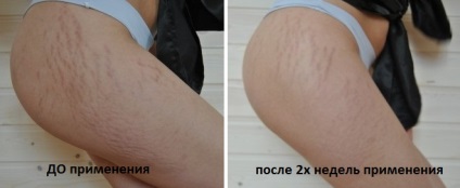 piele curată timp de 2 luni, vă voi spune cum sa scapi de vergeturi pentru totdeauna! (Scapă de) piele curată timp de 2 luni, vă voi spune cum sa scapi de vergeturi pentru totdeauna!