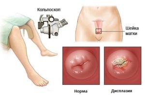 Displazii cervicale special cauzelor și a simptomelor (în special) Displazie de col uterin anumite cauze și simptome