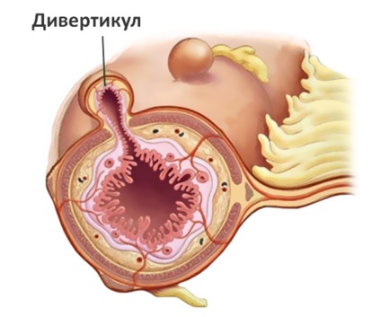 Diverticul esofagului cauze, simptome, tratament si prognosticul (cauza) Diverticul al esofagului cauze, simptome, tratament si prognostic