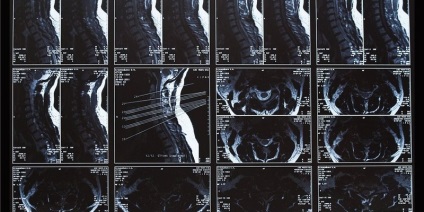 Extrudare discuri spinarii, ceea ce este, un tratament de diagnostic (tratament) Extrudare discuri spinarii, ceea ce este, un tratament diagnostic