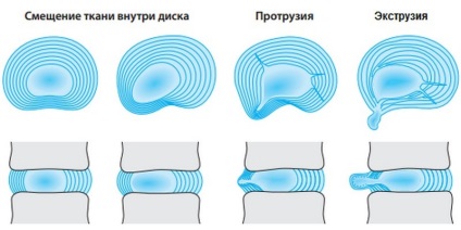 Extrusion discuri spinarii, ceea ce este, de tratament de diagnostic (de extrudare spinarii discuri ca acesta este punctul de vedere cervicale Departamentul lombare toracice ca un tratament decat o interventie chirurgicala pentru diagnostic) Extrudare discuri spinarii, ceea ce este, un tratament diagnostic