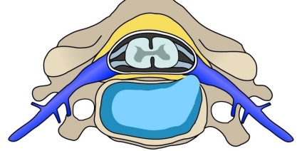 Extrudare discuri spinarii, ceea ce este, un tratament de diagnostic (extrudare) Extrudare discuri spinarii, ceea ce este, un tratament diagnostic