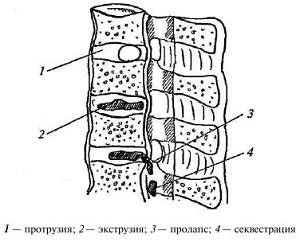 Extrudarea disc intervertebral ceea ce este, ceea ce este tratamentul bolii (extrudare) Extrudarea discului intervertebral ceea ce este, ceea ce este tratamentul bolii