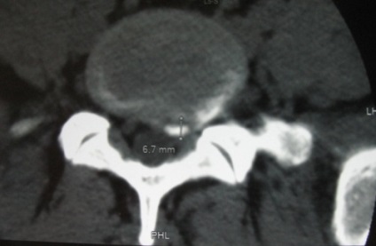 Extrudarea disc intervertebral ceea ce este, ceea ce este tratamentul bolii (extrudare a discului intervertebral dorsal subligamentarnaya) Extrudarea discului intervertebral ceea ce este, ceea ce este tratamentul bolii