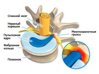 Extrudarea discului intervertebral, ceea ce este (intervertebral) Extrudarea discului intervertebral, ceea ce este