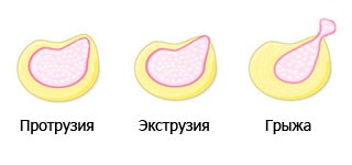Extrudarea discului intervertebral, ceea ce este (ROM) Extrudarea discului intervertebral, ceea ce este