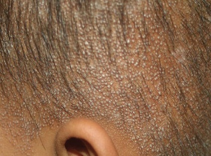 piele fotografie hiperkeratoza foliculare, cauze si tratament (foliculare) Folicular hiperkeratoza fotografie piele, cauze si tratament
