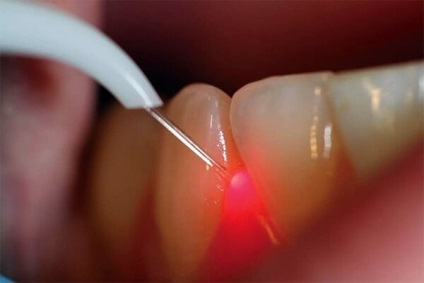 etiologie hipertrofică gingivite, forma, tratament (gingivită cronică hipertrofică) Hipertrofică gingivite etiologie, forma, tratament