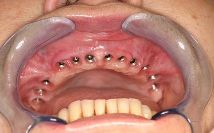 Implanturile dentare 1 maxilo (rândul superior de dinți) Implanturile dentare ale maxilarului superior 1