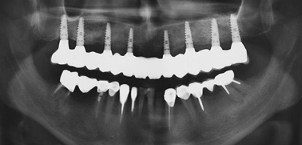 Implanturile dentare 1 maxilo (rândul superior de dinți) Implanturile dentare ale maxilarului superior 1