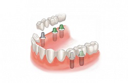 Implanturile dentare ale maxilarului superior (dinți) Implantarea maxilarului superior