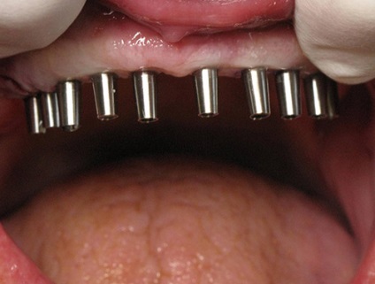 Implanturile dentare ale maxilarului superior 1 (implantare) Implanturile dentare ale maxilarului superior 1