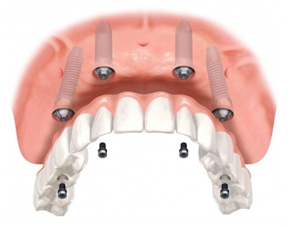 Implanturile dentare ale maxilarului superior 1 (dinți) Implanturile dentare ale maxilarului superior 1