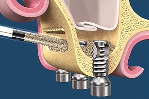 Implanturile dentare maxilar (superior) Implantarea maxilarului superior