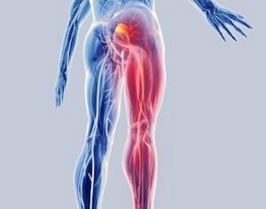 Simptomele sciatică și tratamentul la domiciliu (nervul sciatic) simptome sciatica si tratament la domiciliu