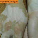 Cum de a ascunde sau vopsea vitiligo și modalități de bază de a face cu ea - foto, video (vitiligo) Cum de a ascunde sau vopsea vitiligo și modalități de bază de a face cu ea - foto, video