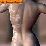 Cum de a ascunde sau vopsea vitiligo și principalele modalități de abordare a acestora - fotografii, clipuri video (de bază) Cum de a ascunde sau vopsea vitiligo și modalități de bază de a face cu ea - foto, video