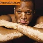 Cum de a ascunde sau vopsea vitiligo și principalele modalități de abordare a acestora - fotografii, clipuri video (de bază) Cum de a ascunde sau vopsea vitiligo și modalități de bază de a face cu ea - foto, video