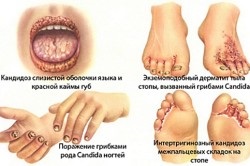 Candidoza a simptomelor gât și tratamentul