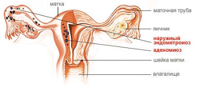 Tratamentul uterin adenomioza Duphaston (adenomioza) Tratamentul uterin adenomioza djufaston