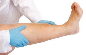 Limfostazom inferioare medicatie la domiciliu (lymphostasis) extremități inferioare medicație limfostazom la domiciliu