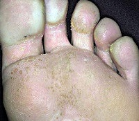 Punctiformă keratolysis - cauze, simptome, diagnostic si tratament (cauza) Punctiformă keratolysis - cauze, simptome, diagnostic și tratament