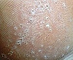Punctiformă keratolysis - cauze, simptome, diagnostic si tratament (punctiformă) Punctiformă keratolysis - cauze, simptome, diagnostic și tratament