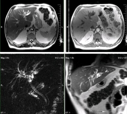 Expert RMN, diagnosticul RMN al bolilor de ficat