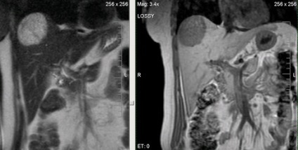 Expert RMN, diagnosticul RMN al bolilor de ficat