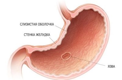 arsuri la stomac omez deoarece ajută, descrierea medicamentului (ajută) Omez arsuri la stomac, deoarece ajută, rezumatul produsului