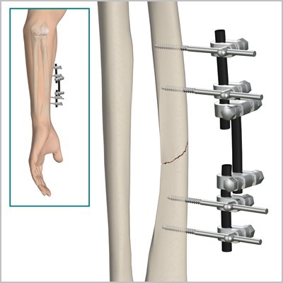 fractura deschisă a oaselor antebrațului (fracturi ale antebrațului) fractură deschisă de antebraț