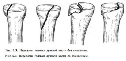 Cap de simptome fracturi raza, cauzele si tratamentul (punct de cotitură) Cap de simptome fracturi raza, cauze si tratament