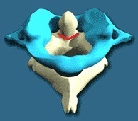 fractură odontoid de-a doua vertebre cervicale (neconsolidată fara offset) Clinic,