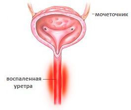 De ce partea dreapta dureri ale bolii, diagnostic, tratamente (partea dreapta) De ce doare partea dreapta a bolii, diagnostic, tratament