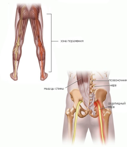 Cauzele și tratamentul sciaticii ( „piriformis sindrom“) Cauzele și tratamentul sciaticii