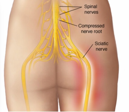 Cauzele și tratamentul sciaticii (nervul sciatic) Cauzele și tratamentul sciaticii