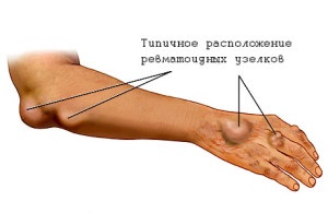 Reumatism - cauze, simptome si remedii populare tratarea reumatismului