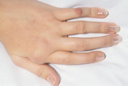 noduli reumatoizi (foto) (durere care cauzează) noduli reumatoizi (foto)
