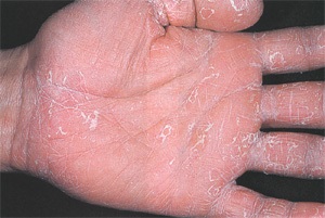 Descuamarea pielii de pe palme și tălpi cu keratolysis exfoliativă