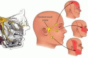 Simptomele și tratamentul nervului trigemen (trigemen) Simptomele și tratamentul nevralgie de trigemen