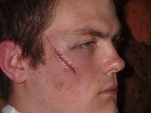 Interpretare vis cicatrice pe corp, fata, abdomen, brațul în somn pentru a vedea ce vise (vise acea carte vis cicatrice burta pentru a vis fata chirurgie cicatrice om visat visat să vadă) Interpretare vis cicatrice pe corp, fata, abdomen, brațul în somn pentru a vedea ce vise