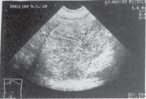 Examinarea cu ultrasunete a bolii hepatice (diagnosticare) Examinarea cu ultrasunete a bolii hepatice