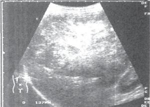 Examinarea cu ultrasunete a bolii hepatice (chirurgie) Examinarea cu ultrasunete a bolii hepatice