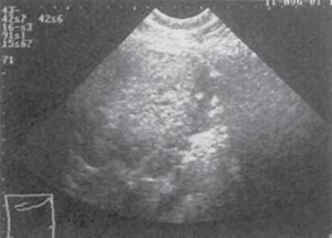 Examinarea cu ultrasunete a bolii hepatice (patologie) Examinarea cu ultrasunete a bolii hepatice