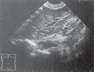 Examinarea cu ultrasunete a bolii hepatice (cu ultrasunete) Examinarea cu ultrasunete a bolii hepatice