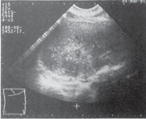 Examinarea cu ultrasunete a bolii hepatice (cu ultrasunete) Examinarea cu ultrasunete a bolii hepatice