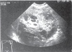 Examinarea cu ultrasunete a bolii hepatice (chist) Examinarea cu ultrasunete a bolii hepatice