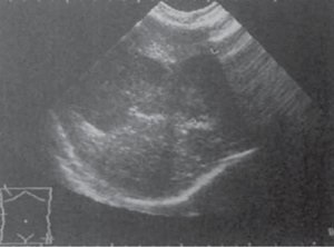 Examinarea cu ultrasunete a bolii hepatice (operare) Examinarea cu ultrasunete a bolii hepatice