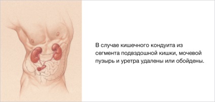 Urostomy, Hollister (bucla a intestinului subțire) Urostomy, Hollister