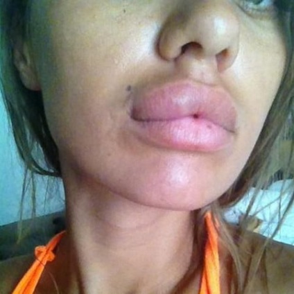 selecție Lip gel augmentarea umpluturii optim (gel) selecție Lip gel augmentarea umpluturii optim